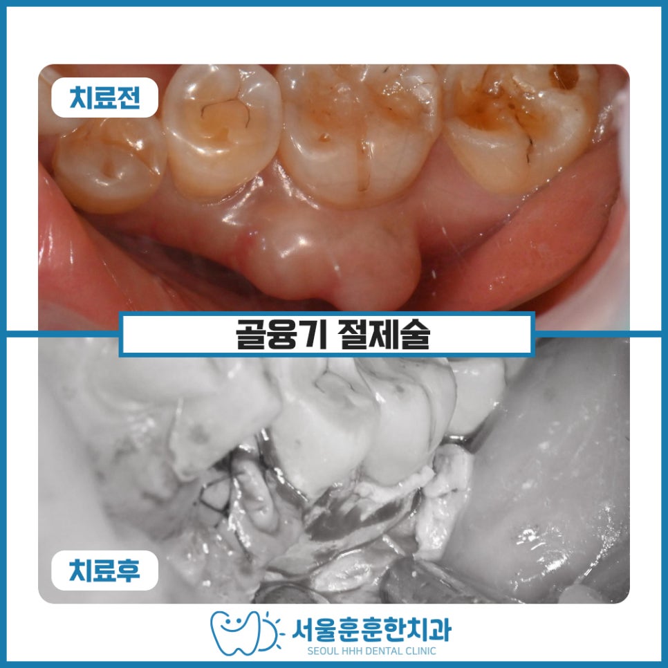광진구치과골융기절제술