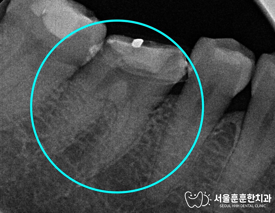 자연치아보존치과선택