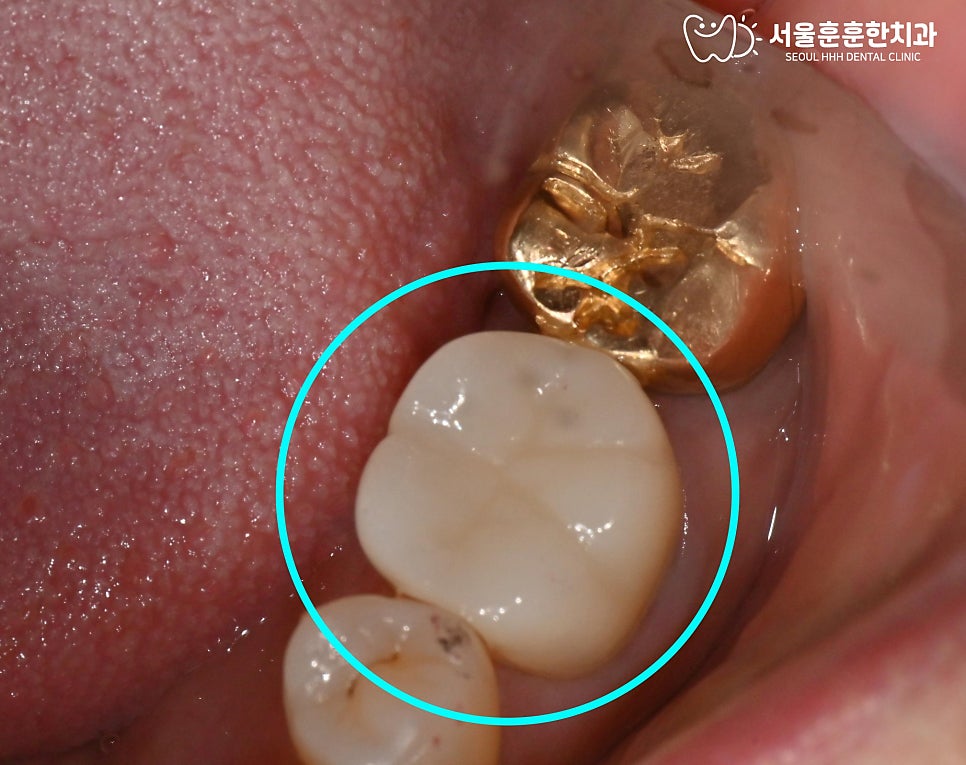 자연치아살리기치료과정