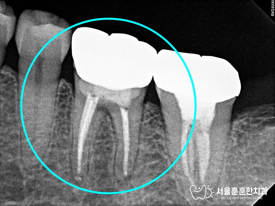 치아뿌리염증신경치료