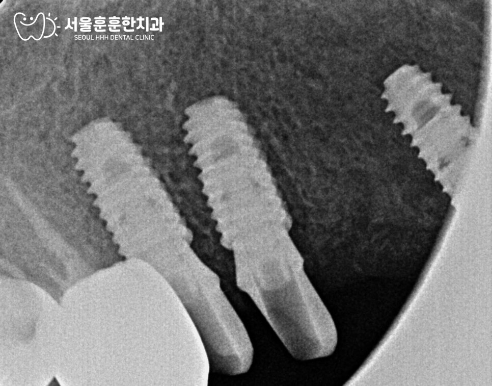 치아살리는보존치료법