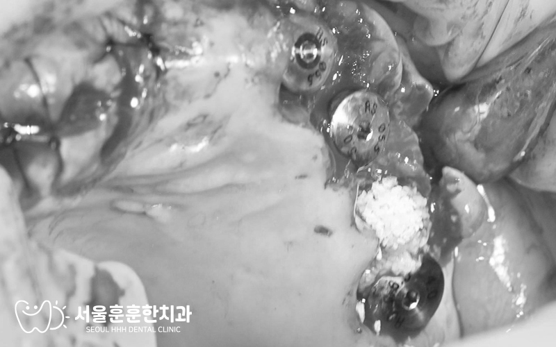 광진구수면치과사랑니수면
