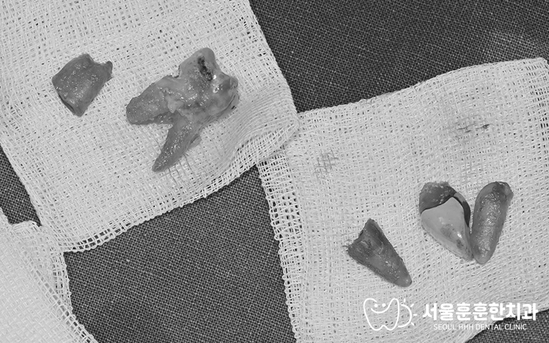 광진구어금니임플란트