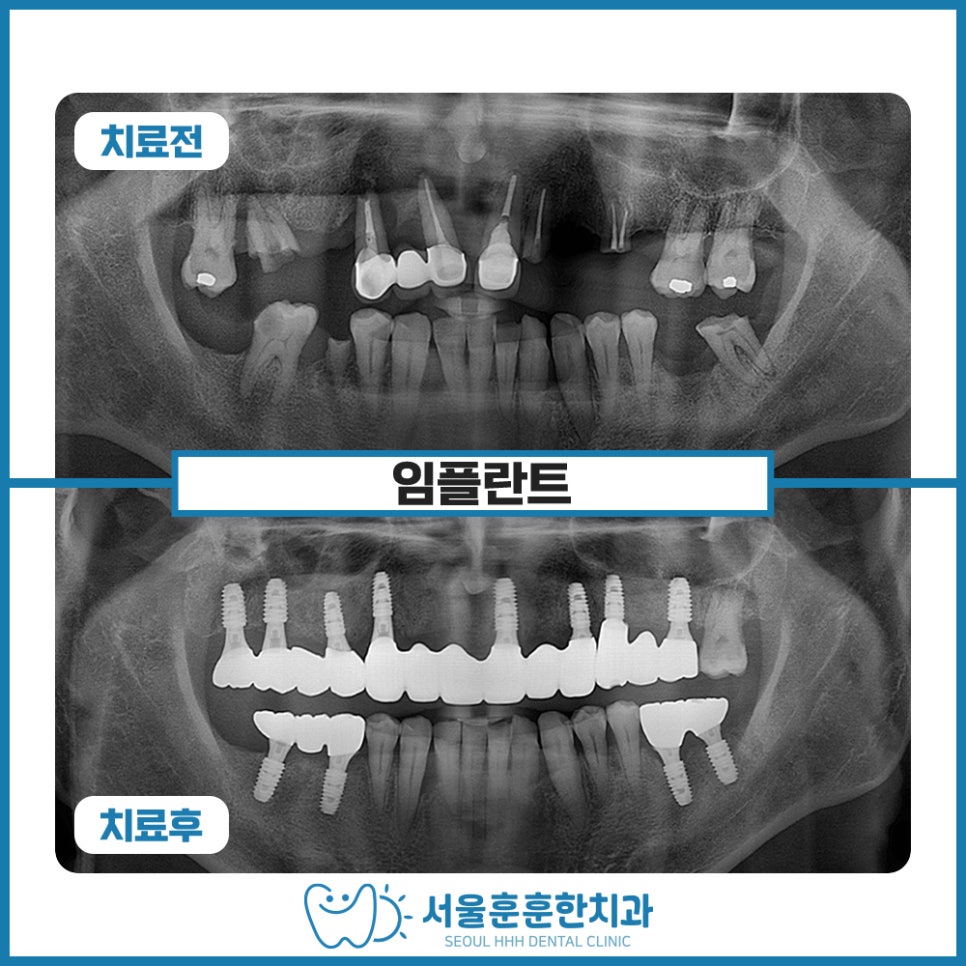 광진구치과치료후기