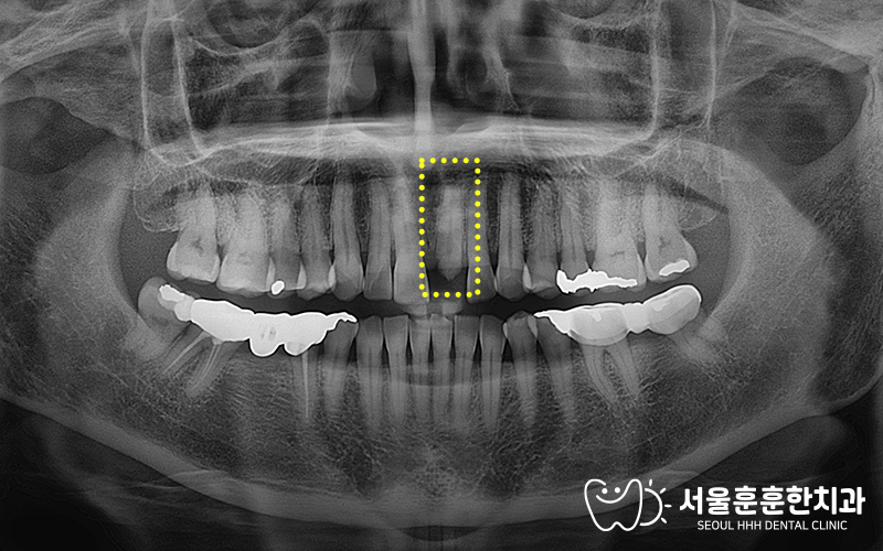 광진구내원당일임플란트