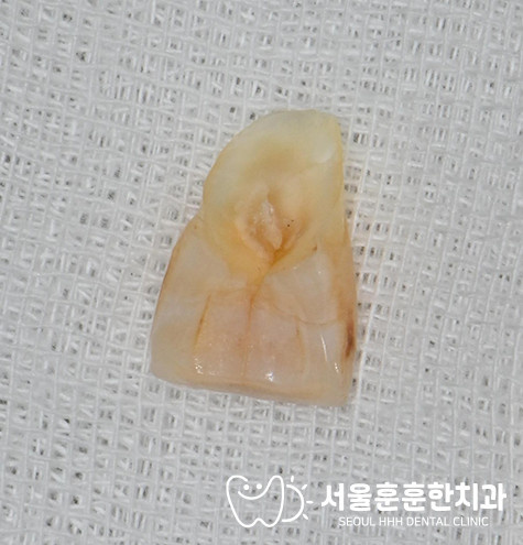 광진구임플란트전문치과