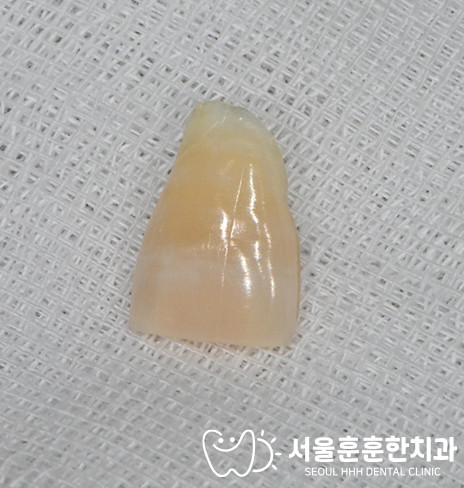 광진구임플란트추천치과