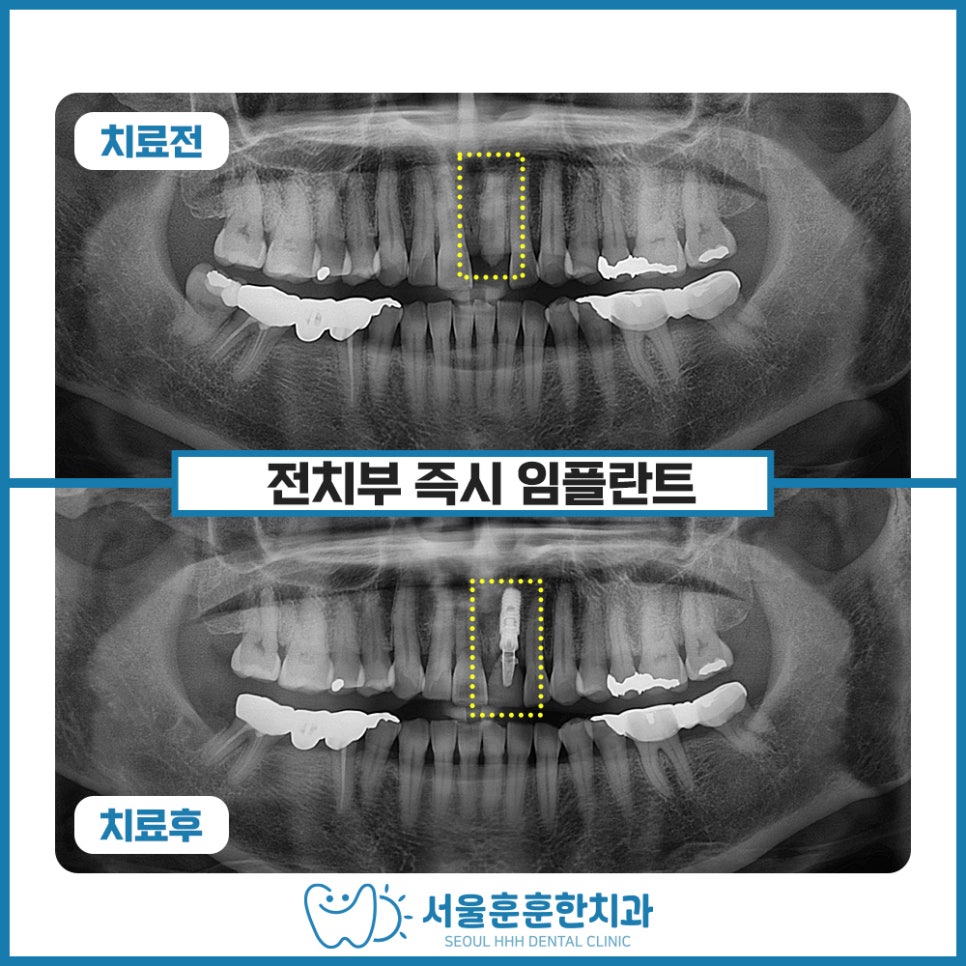 광진구즉시임플란트치과