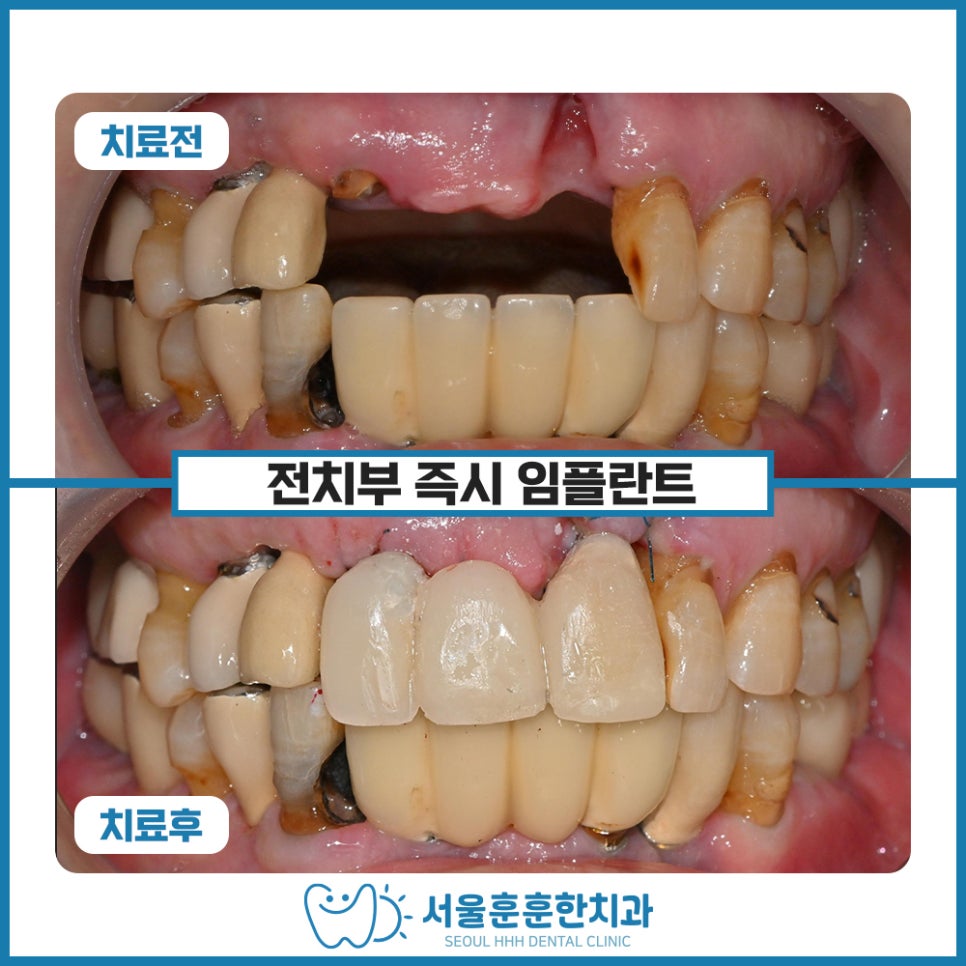 자양동즉시임플란트