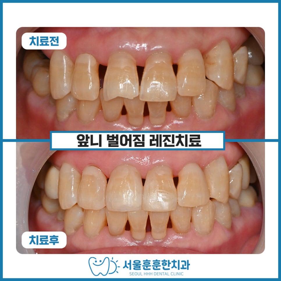 광진구치과 에서 소개하는 벌어진 앞니 사이 레진치료