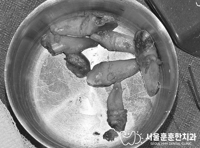 앞니 6개를 발치하고 염증을 깨끗하게 제거한 상태