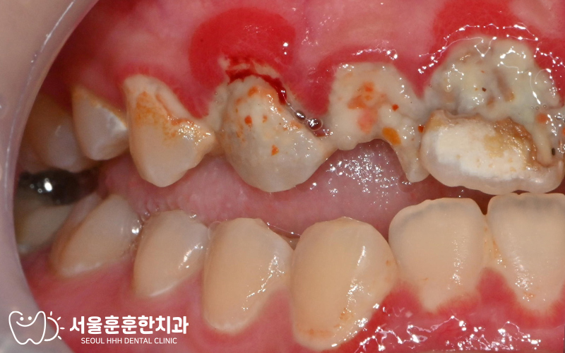 앞니가 너무 불편해 처음 내원한 환자의 구강 상태