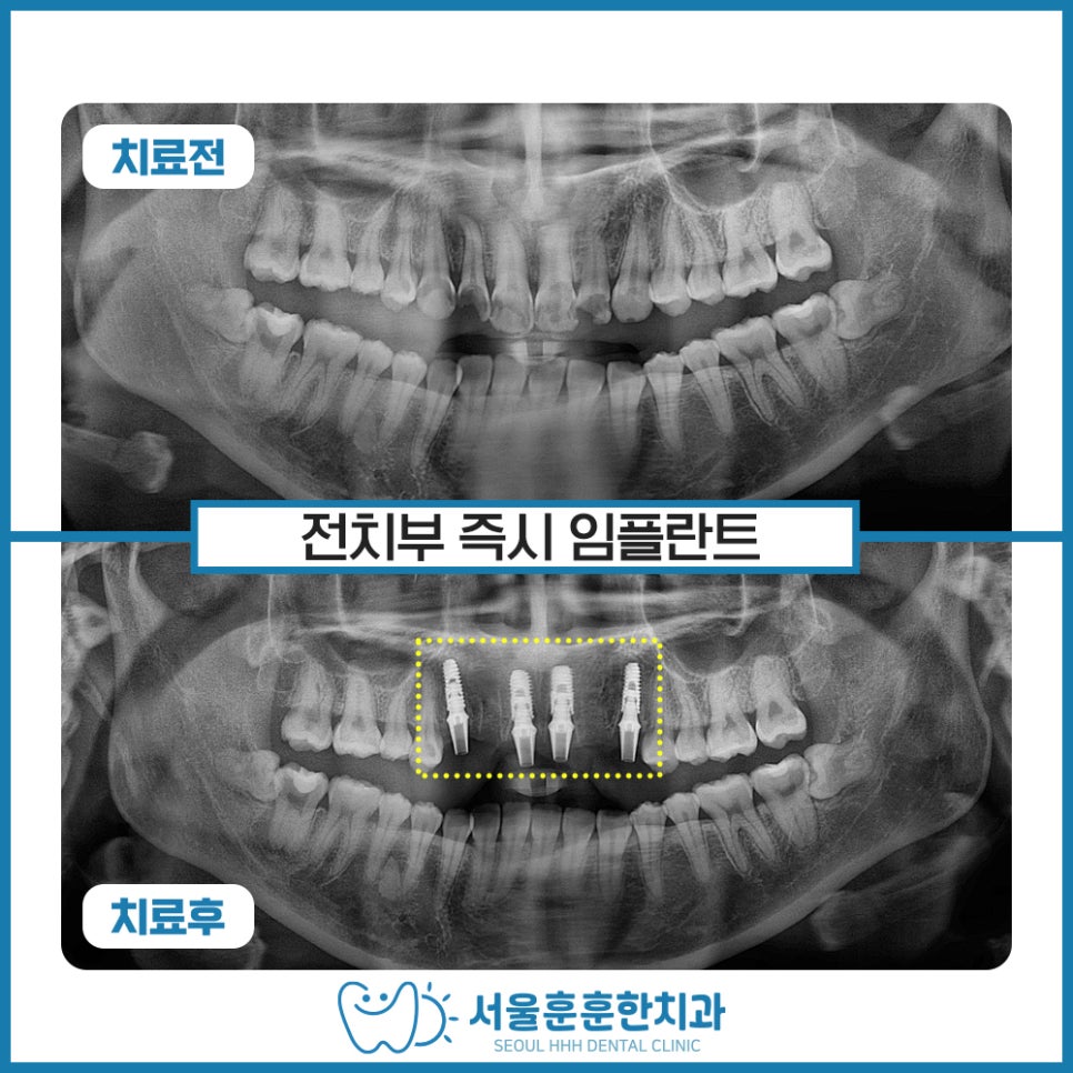 광진구치과에서 안내하는 앞니 발치 당일 즉시 임플란트 식립