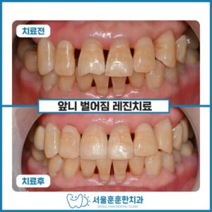 광진구치과 에서 소개하는 벌어진 앞니 사이 레진치료