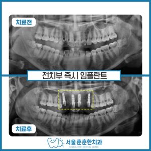 광진구치과에서 안내하는 앞니 발치 당일 즉시 임플란트 식립